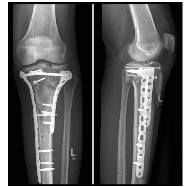 Double-buttress-plating-and-reconstruction-of-the-joint-lines