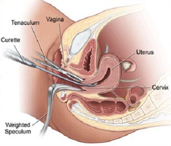 abs-gyn-01