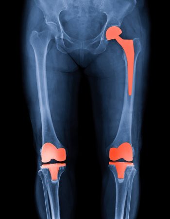 Xray scan of patient who have hip replacement and knee arthroplasty (knee replacement) treatment for Osteoarthritis knee, hip arthritis, Osteonecrosis of Hip. After surgery patient can walk normally