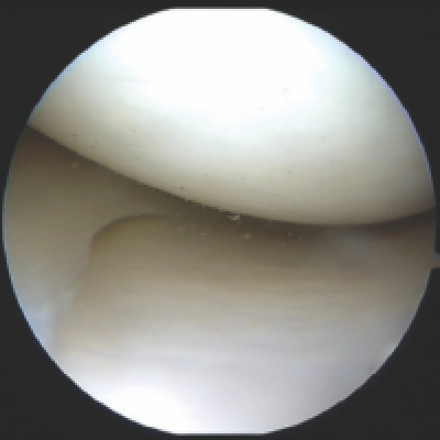 knee-arthroscopy-img-03