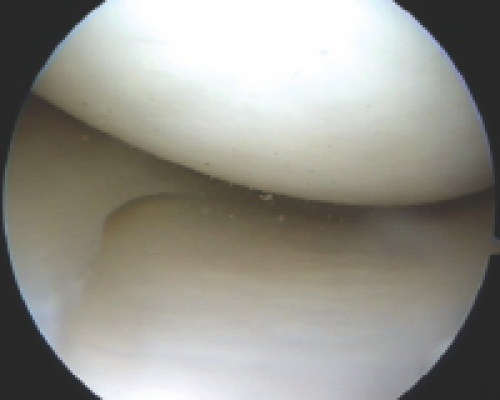 knee-arthroscopy-img-03