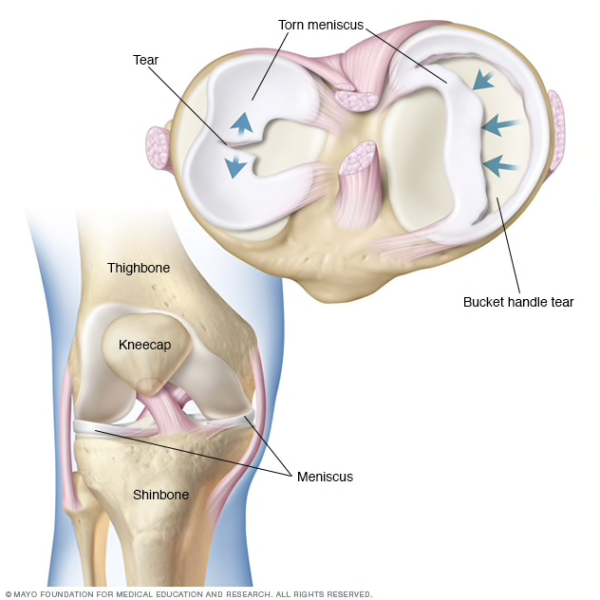 meniscus-img-01