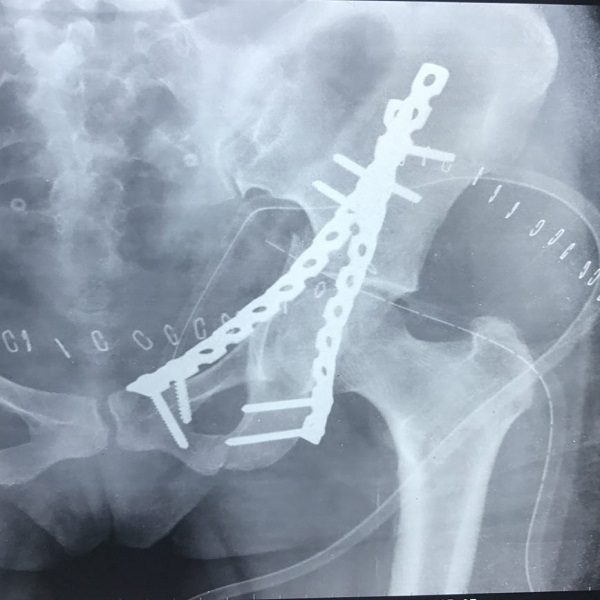 pelvic-acetabular-fracture-2