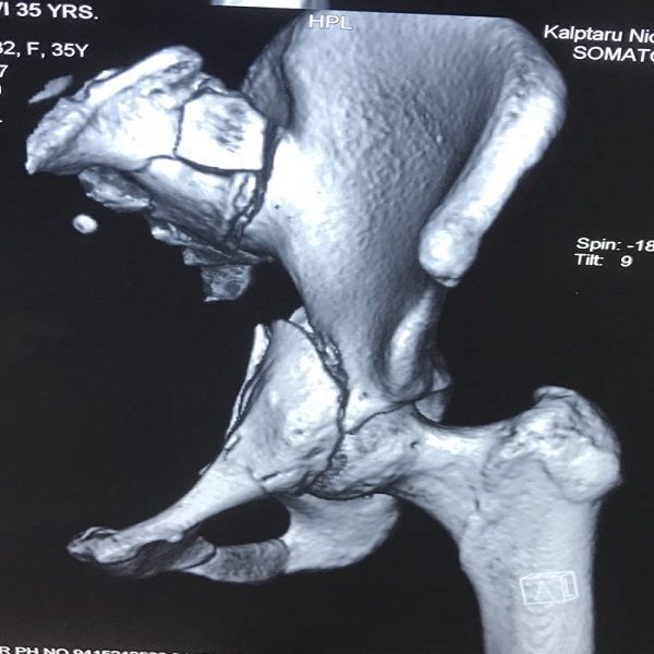 pelvic-acetabular-fracture