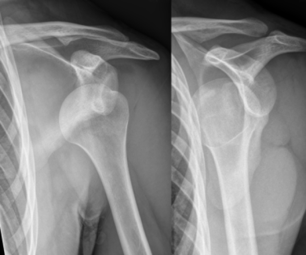 shoulder-dislocation-img-02